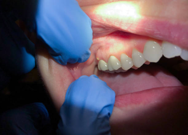 Best Emergency Dentist for Lost Fillings or Crowns in Seymour, IN